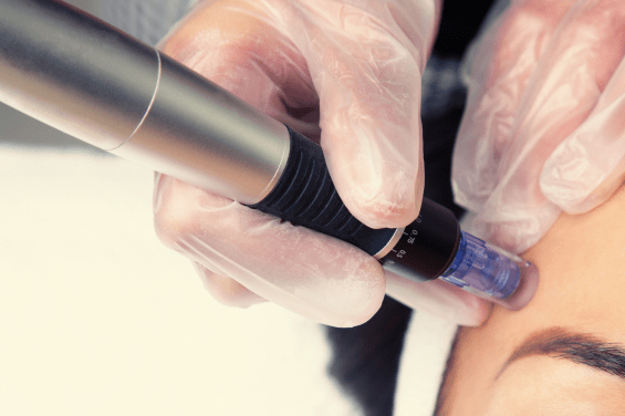 Microneedling met PRP: Combineer PRP met microneedling voor verbeterde huidtextuur en collageenproductie.