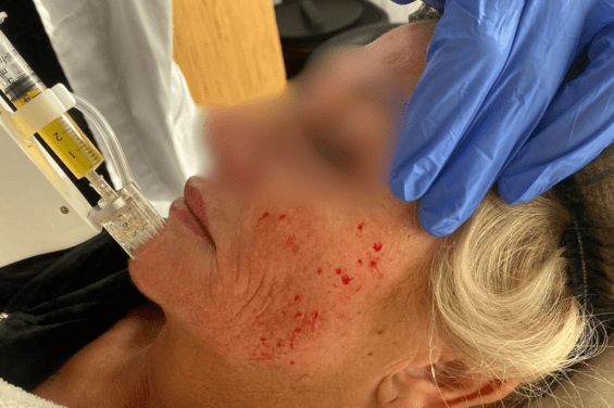 prp antwerpen vampire facial