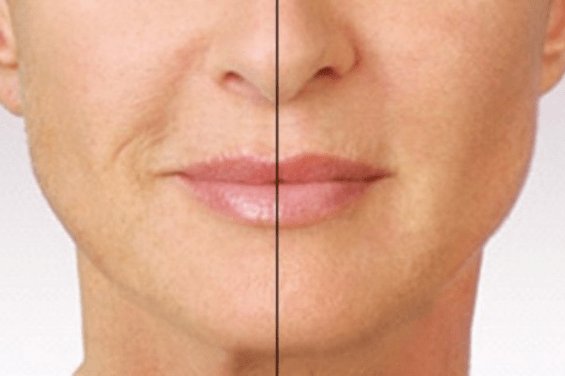 sunekos antwerpen behandeling-min