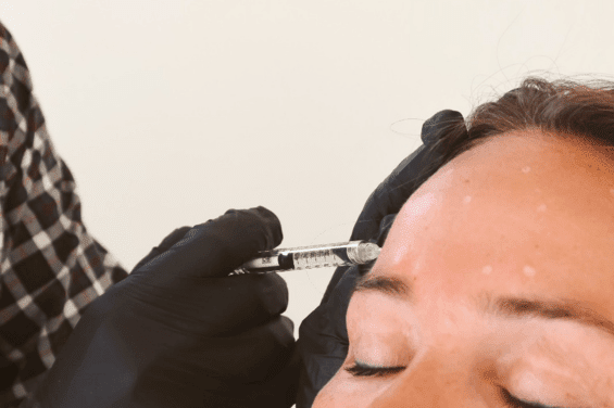 botox antwerpen voorhoofd