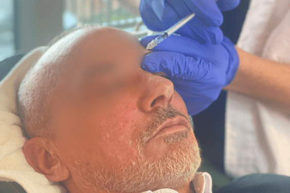 botox-antwerpen-rimpel