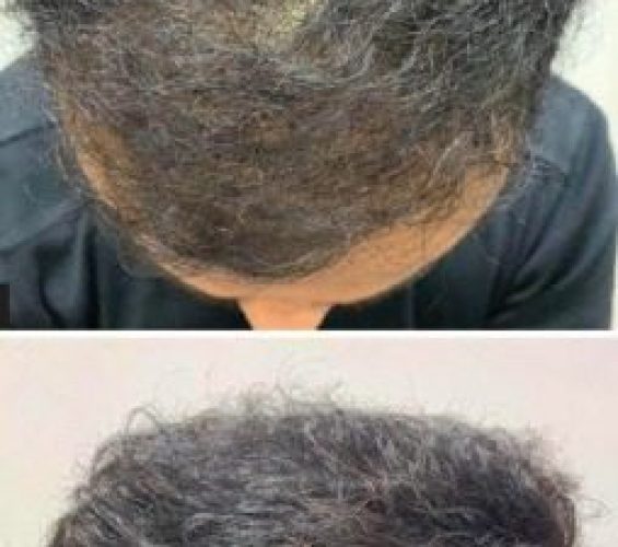 Haarfillers voor haaruitval