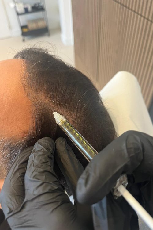 PRP voor haarstimulatie