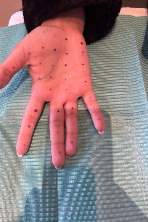 Botulinetoxine voor overmatig zweten ter hoogte van de handen