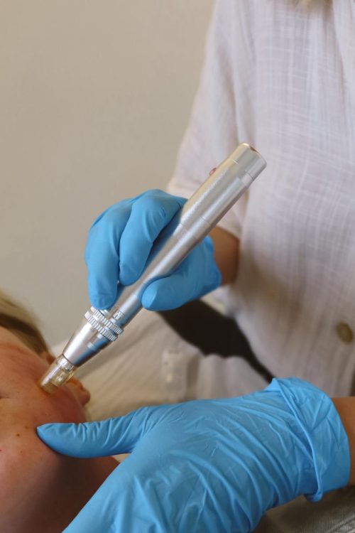 PRP microneedling