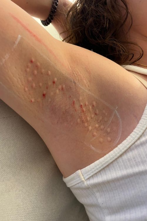 Botulinetoxine voor overmatig zweten ter hoogte van de oksels