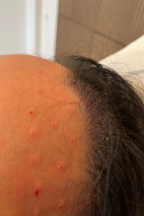 Botulinetoxine voor overmatig zweten ter hoogte van het voorhoofd