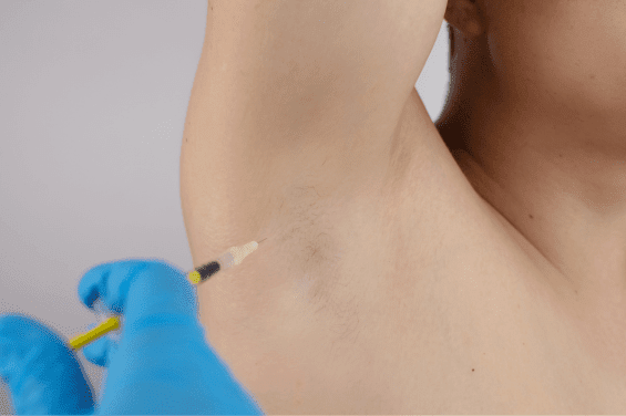 botox-overmatig-zweten-antwerpen